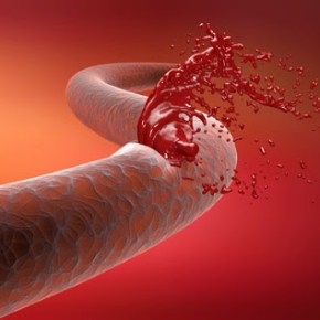 Hemofilia: Se necesitan más diagnósticos y acceso a tratamientos innovadores en personas afectadas para frenar el&nbsp;desempleo