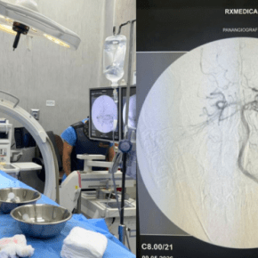 Vanguardia médica: Hospital Santa Rosa de Pueblo Libre realiza su primer neurointervencionismo endovascular que en lugar de abrir el cráneo, con microcatéteres se navegó hasta llegar a la&nbsp;lesión